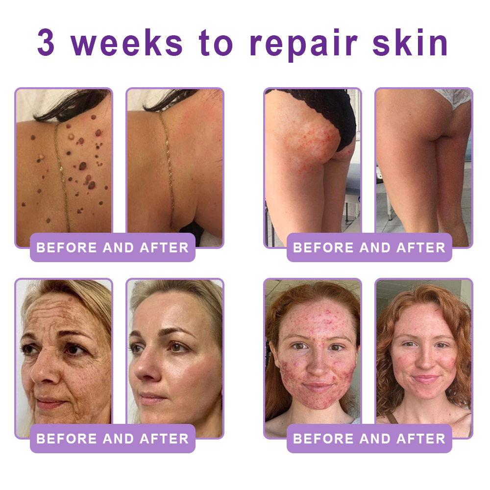 Vitalisys® 🍅PDRN Multi-Peptide Massaging Body Roller Cream- Anti-aging, Hydrating, Skin Firming & Lifting, Skin Repair, Even Tone, Acne and Dark Spot Treatment, Wart and Mole Removal, and Psoriasis Relief.