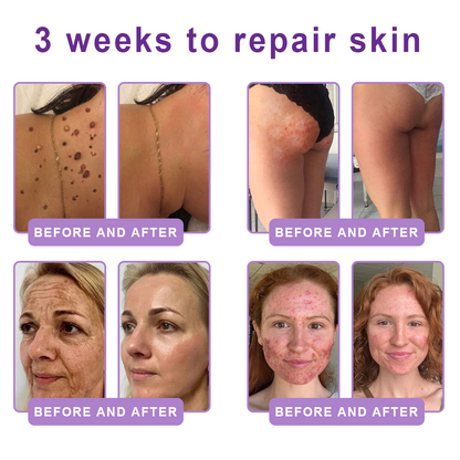 Vitalisys® 🍅PDRN Multi-Peptide Massaging Body Roller Cream- Anti-aging, Hydrating, Skin Firming & Lifting, Skin Repair, Even Tone, Acne and Dark Spot Treatment, Wart and Mole Removal, and Psoriasis Relief.