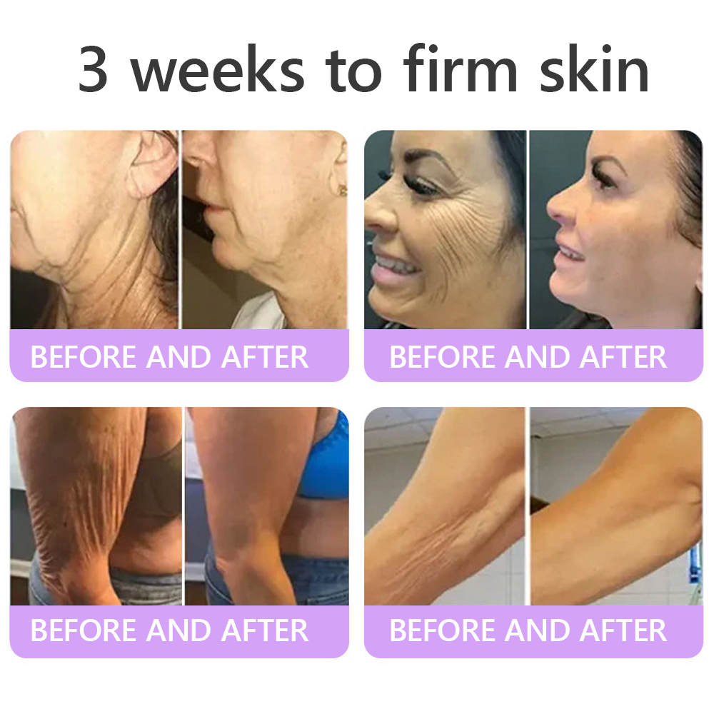 Vitalisys® 🍅PDRN Multi-Peptide Massaging Body Roller Cream- Anti-aging, Hydrating, Skin Firming & Lifting, Skin Repair, Even Tone, Acne and Dark Spot Treatment, Wart and Mole Removal, and Psoriasis Relief.