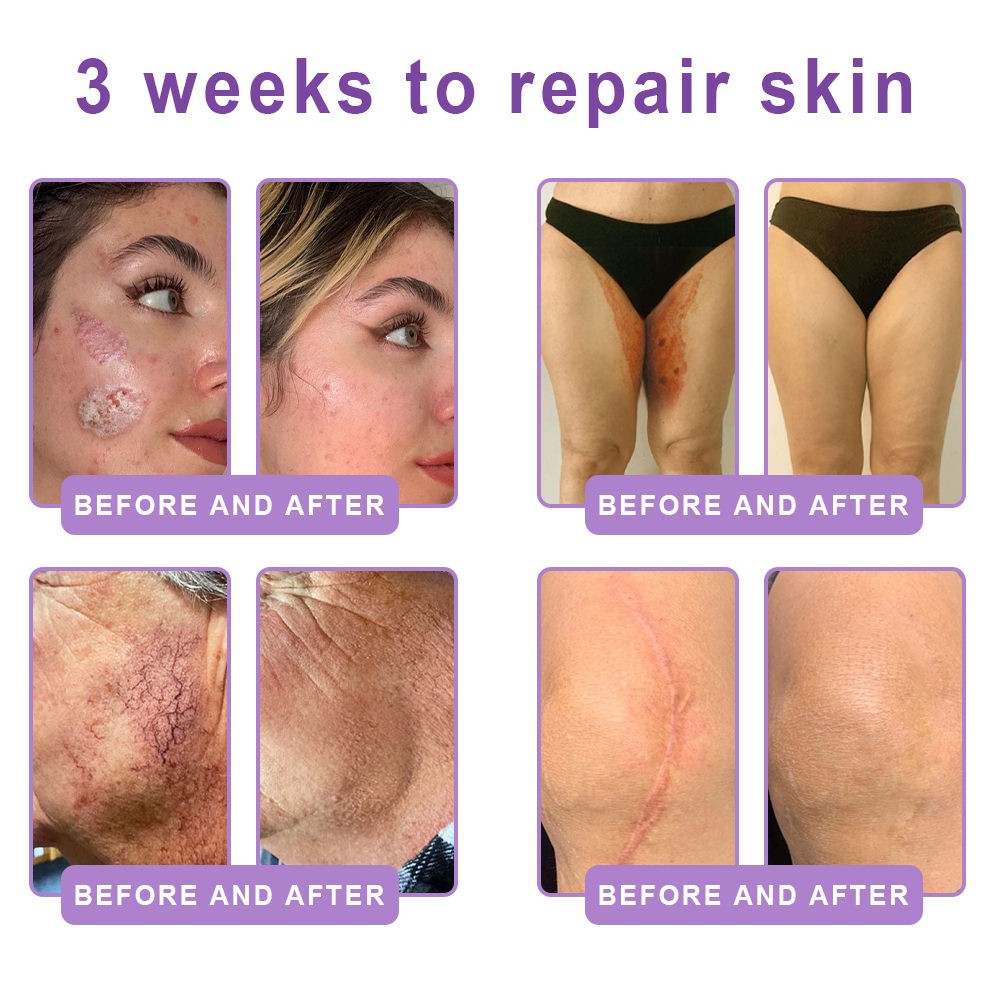 Vitalisys® 🍅PDRN Multi-Peptide Massaging Body Roller Cream- Anti-aging, Hydrating, Skin Firming & Lifting, Skin Repair, Even Tone, Acne and Dark Spot Treatment, Wart and Mole Removal, and Psoriasis Relief.