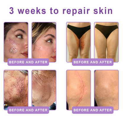 Vitalisys® 🍅PDRN Multi-Peptide Massaging Body Roller Cream- Anti-aging, Hydrating, Skin Firming & Lifting, Skin Repair, Even Tone, Acne and Dark Spot Treatment, Wart and Mole Removal, and Psoriasis Relief.